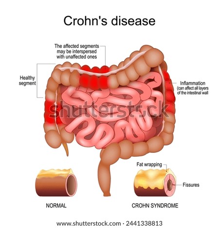 Crohn disease. Human large and small intestine with Healthy segments and Inflammation that affect  layers of the intestinal wall. Close-up of a cross section of a intestinal wall with Fat wrapping