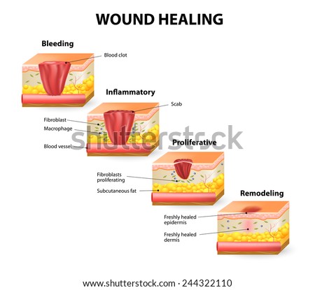 Phases Of The Wound Healing Process. Hemostasis, Inflammatory ...