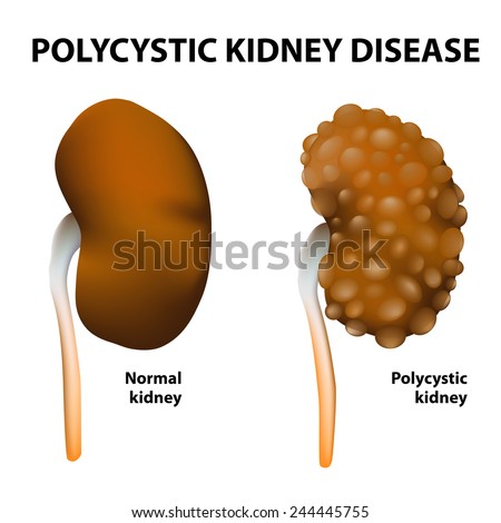 Polycystic Kidney Disease. Normal And Polycystic Kidneys Stock Vector ...