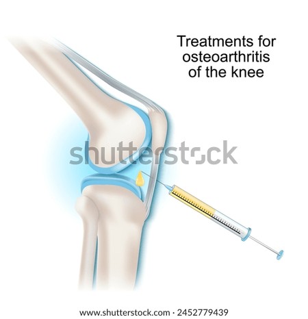 Treatments for osteoarthritis of the knee joint. Syringe and Intra-articular injection. Vector illustration.
