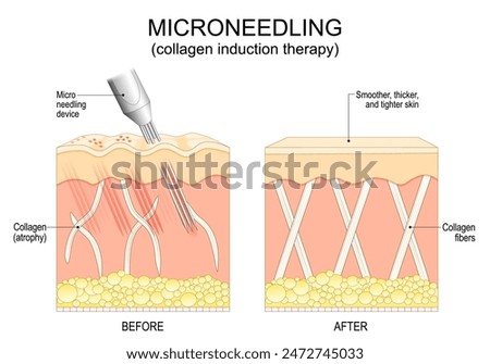 Microneedling procedure. Cross section of a human skin before and after collagen induction therapy. Skin rejuvenation. Anti-aging treatment. Surgical for remove wrinkles, scars, stretch, marks