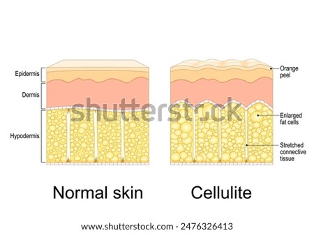 Cellulite formation. Orange peel syndrome.  Adiposis edematosa. Cross section of Cellulite and healthy skin. Skin anatomy. Fat tissue of human body. Vector illustration. Epidermis and dermis texture. 