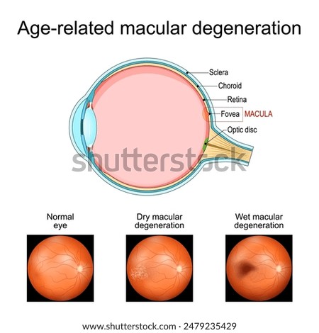 Macular degeneration. Age-related macular degeneration. Cross section of human eye. Close-up of a macula, optic disc, choroid, retina, sclera, fovea. Medical condition. Image of the back of the eye