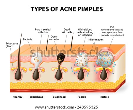 Types Of Acne Pimples. Healthy Skin, Whiteheads And Blackheads, Papules ...