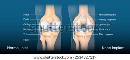 Total knee arthroplasty. Knee joint replacement. Anatomy of Normal joint and Total Knee implant. Detailed vector poster. Isometric flat illustration. Schematic diagram