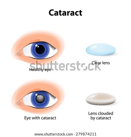 A cataract is an clouding crystalline lens inside the eye. Foto d'archivio © 