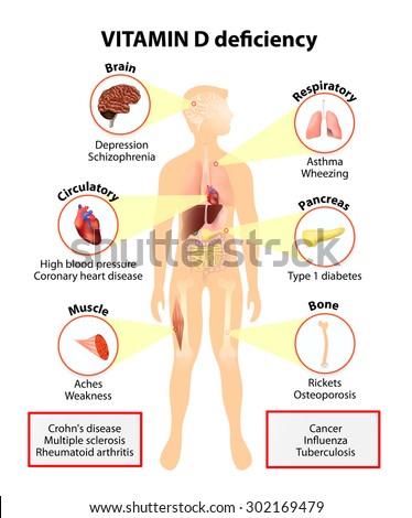 Vitamin D deficiency. symptoms and diseases caused by insufficient vitamin D. Symptoms & Signs. Human silhouette with highlighted internal organs