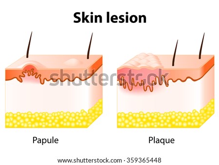 Skin Lesion. Papule Is A Solid Elevation Of Skin And Accumulation Of ...