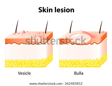 Vesicle And Bulla. Skin Lesion. Bulla Is A Large Vesicle Containing ...