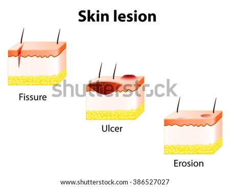 Erosion, Ulcer And Fissure. Skin Lesion. Stock Photo 386527027 ...