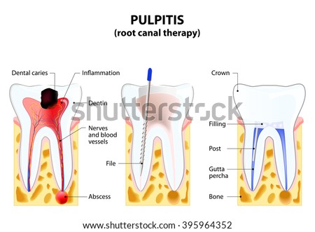 Pulpitis. root canal therapy. Infected pulp is removed from the tooth and the space occupied by it is cleaned and filled with a gutta percha. Post inserted to support crown