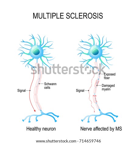 Multiple sclerosis or MS. autoimmune disease. the nerves of the brain and spinal cord are damaged by one's own immune system.