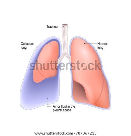 Collapsed lung. abnormal collection of air (pneumothorax) or fluid (pleural effusion) or pus (empyema) in the pleural space between the lung and the chest wall.  Photo stock © 