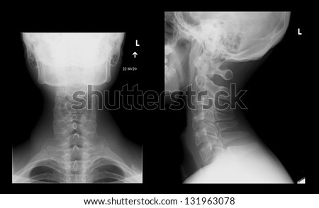 X-ray image of human neck and head.