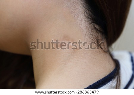 keloid  scar on woman neck