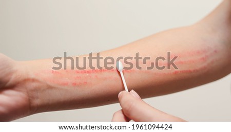 Similar – Image, Stock Photo Abrasion forearm Healthy