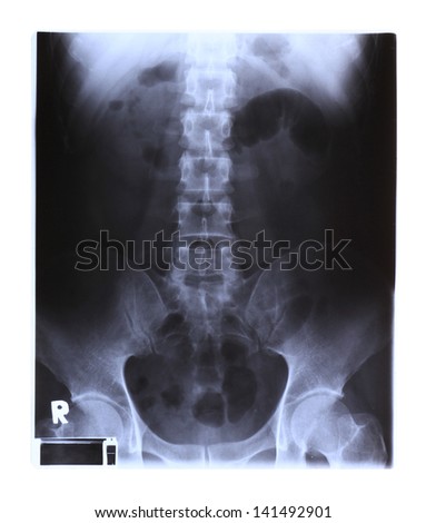 X-ray film of spinal column and pelvis