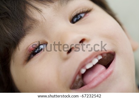 Little boy with a sty on his eye smiling at camera
