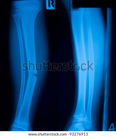 X ray film  of tibia leg fracture