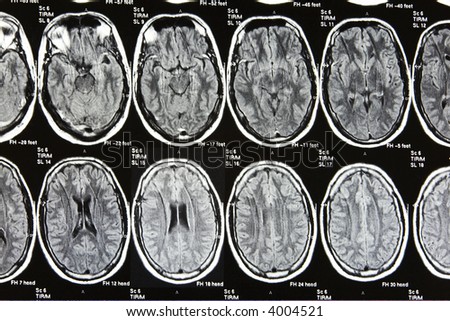 A real MRI/ MRA (Magnetic Resonance Angiogram) of the brain vasculature (arteries) in monochrome