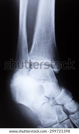 x-ray image of human foot joint , side view