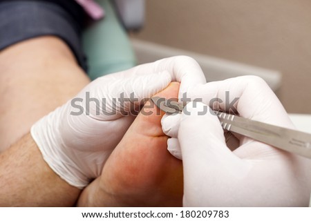 Chiropodists removed with a scalpel Callus on a woman\'s foot