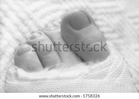 Four toes sticking out of the cast. Black and white. Shallow Depth of Field.