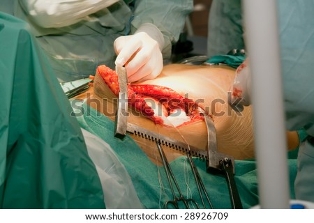 The surgeons hands spends operation on the heart close-up