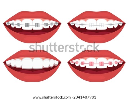 teeth alignment. Metal, ceramic, plastic, ligature and invisible braces