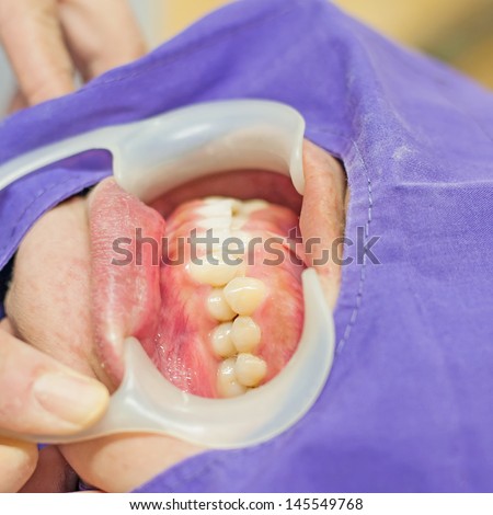 Disorders of the teeth, upper teeth behind lower teeth
