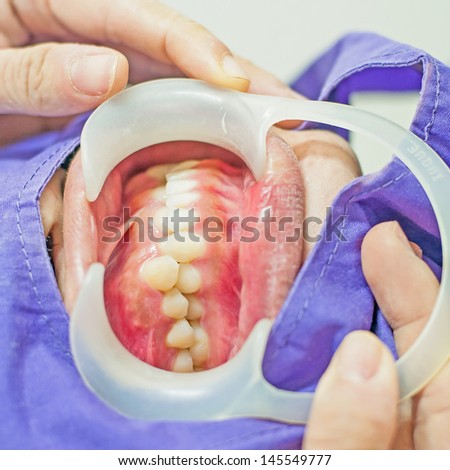 Disorders of the teeth, upper teeth behind lower teeth