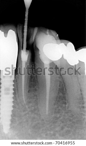 root canal treatment- xray