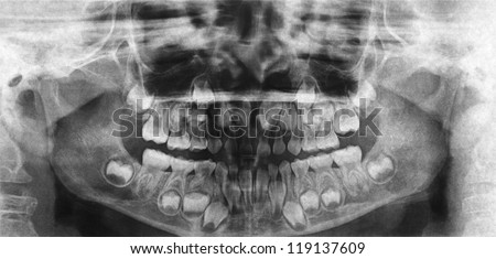 Children Dental X-Ray Stock Photo 119137609 : Shutterstock