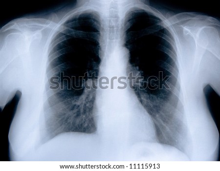 health medical image of an x ray of the chest