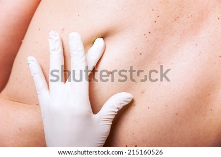 skin examination with lot of moles