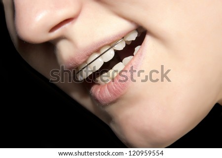 the girl smiling with braces on teeth
