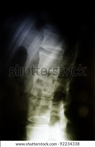 X-ray of the spinal column.