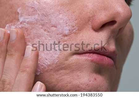 Cream applying to problematic female skin with acne scars