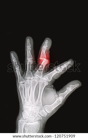 wrist and hand  x-rays image show fracture and dislocation bone
