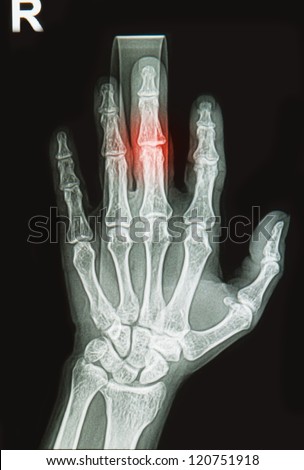 wrist and hand  x-rays image show fracture bone on finger splint