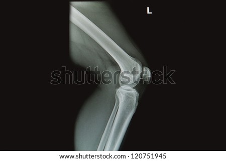 knee joint x-rays image