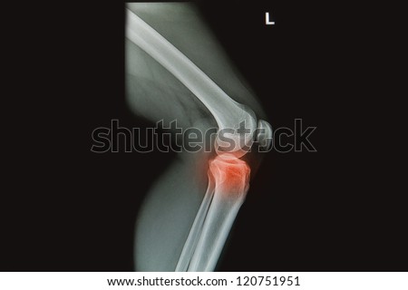x-rays image of  the painful or injury knee joint, knee trauma