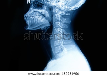 X-ray of  human cervical spine