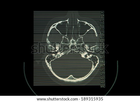 CT ( computed tomography imaging ) scan image of brain.