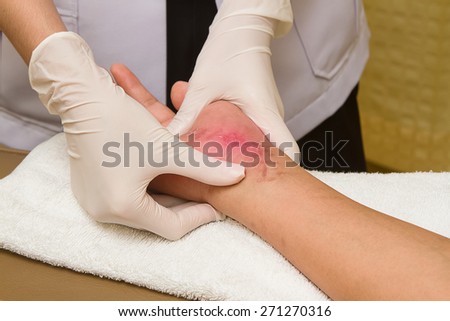 Patient getting a therapy massage on scar,Hand injury 6 weeks after surgery