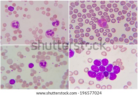 Leukemia Cells,Neutrophil , Lymphocyte , Eosinophil In Human Blood Cell ...