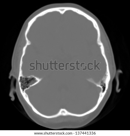 Brain and head CT( computed tomography imaging )