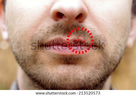 Closeup of a common cold sore virus herpes. Marked cold sores on the lips of a man with a beard