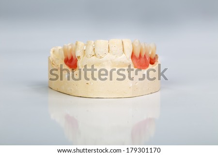 A partial denture mounted on a plaster study model and placed on a shiny gray background