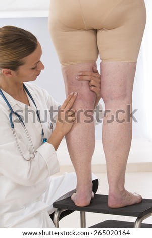 doctor showing varicose veins from an elderly woman